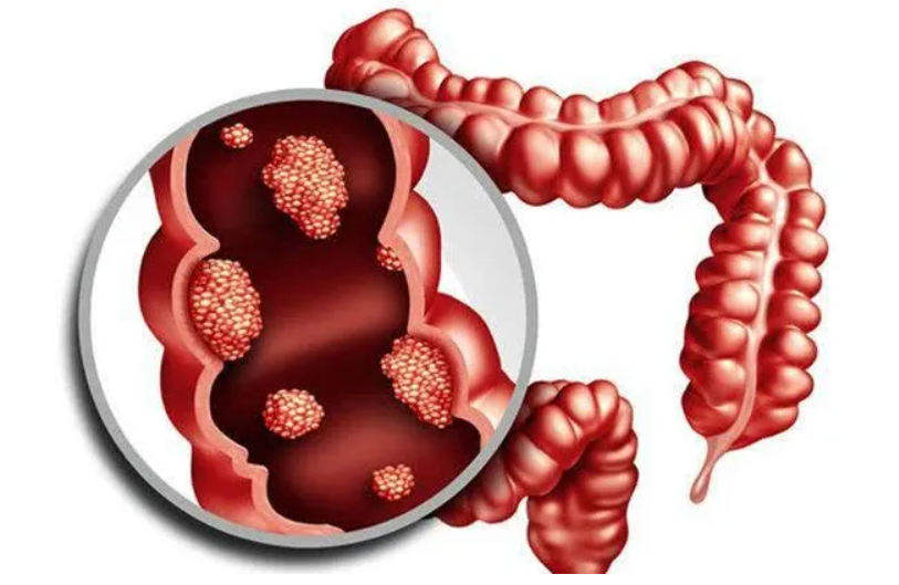Can intestinal polyp become cancerous?