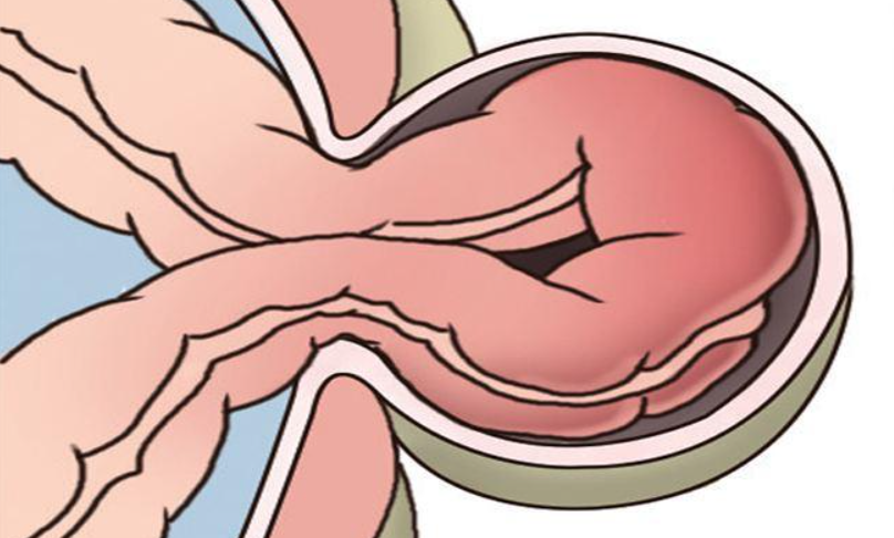 Let's talk about intestinal obstruction